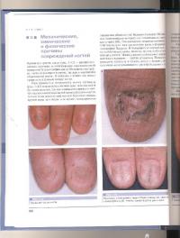 Дифференциальная диагностика поражений ногтей. Атлас — Роберт Бэран, Экарт Ханеке #6